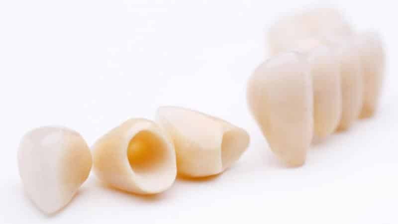 Faste tandproteser nye generation: brobygning systemet