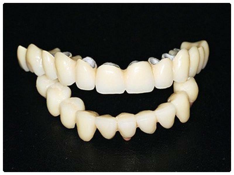 Prosthetics of teeth with cermet: photo and price of metal-ceramic prostheses
