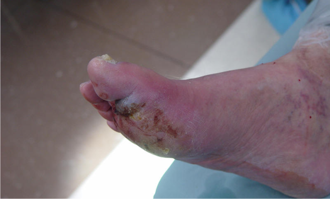 infección del pie