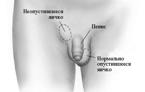 En oacceptabel testikel( kryptorchidism)