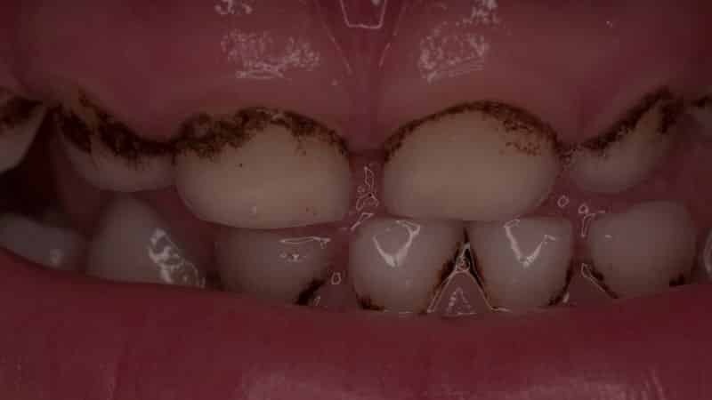 donkerbruin plaque op de tanden van een kind 1 jaar