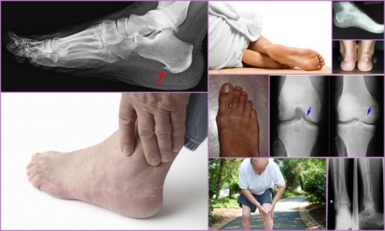 Osteophytes auf Röntgenaufnahmen und Fotos