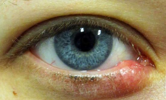Wie Gerste auf dem unteren Augenlid, die Ursachen und mögliche Komplikationen zu behandeln