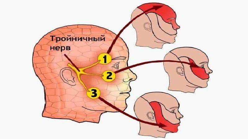 Betændelse i ansigtet nerve: symptomer og behandling i hjemmet