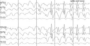 Décodage EEG