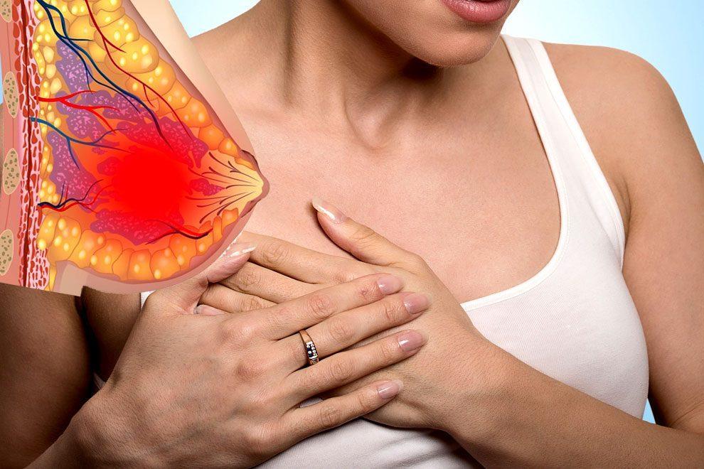 Extreme breast pain
