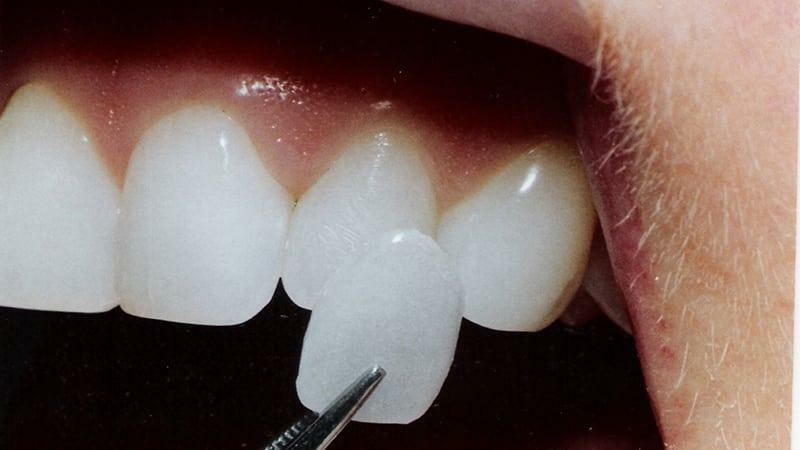 Anpassningen av tänderna utan hängslen: sätt med resultatet