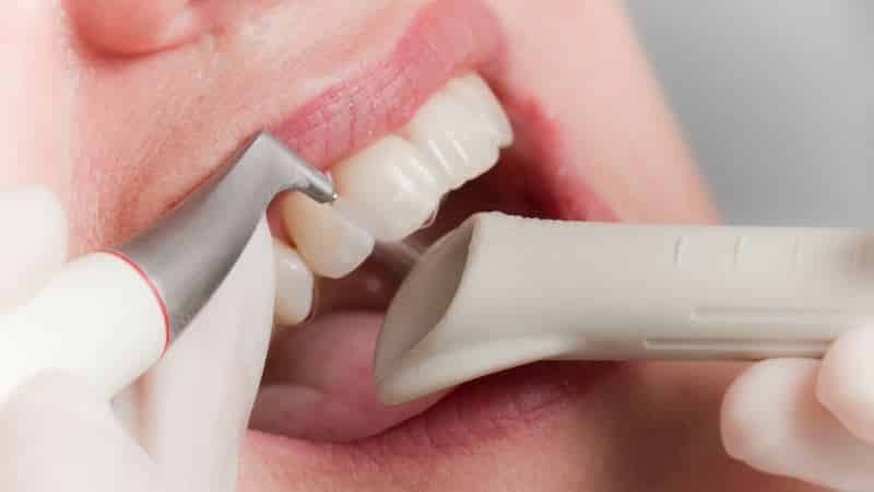 Ultraljuds rengöring av tänderna före och efter bilder