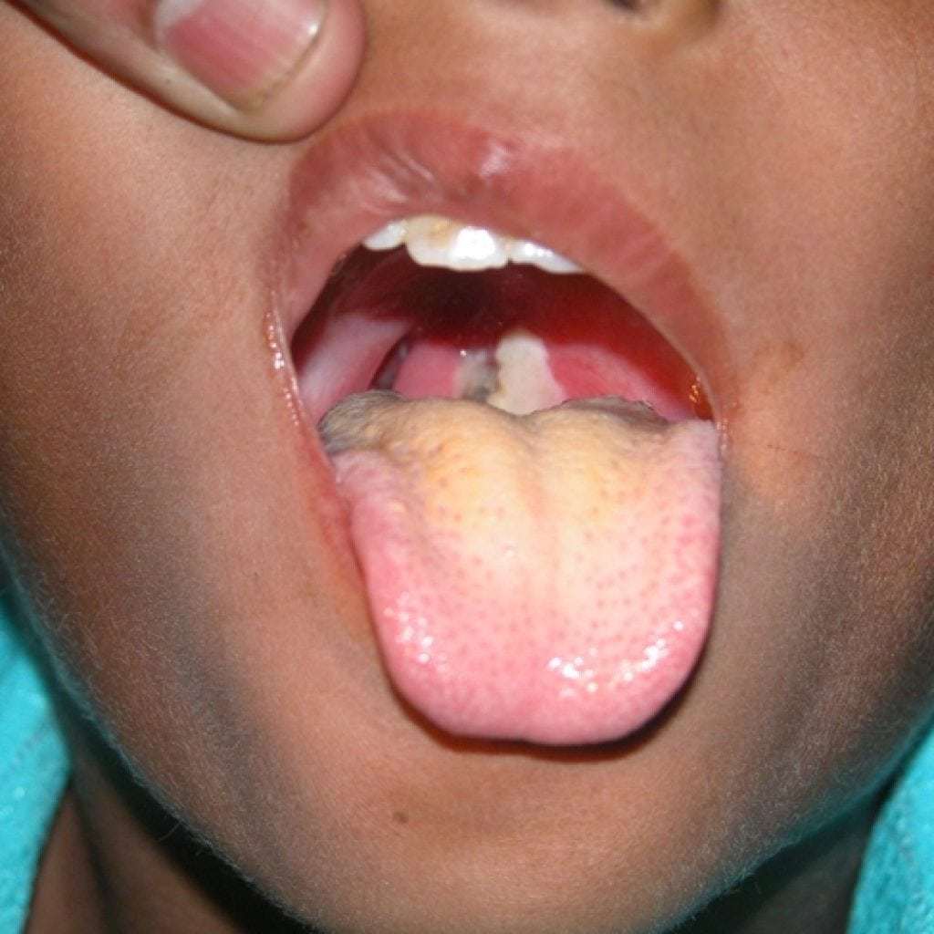 Difteri hos barn, symptom och behandling, förebyggande, foto