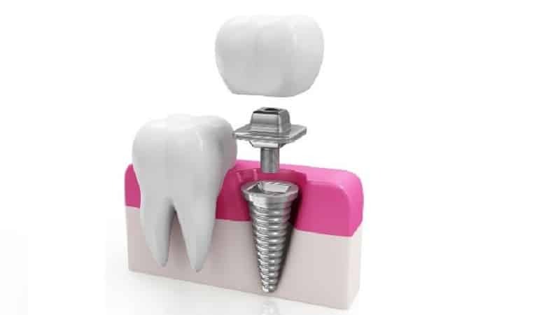 Tijdelijke voorziening per tand