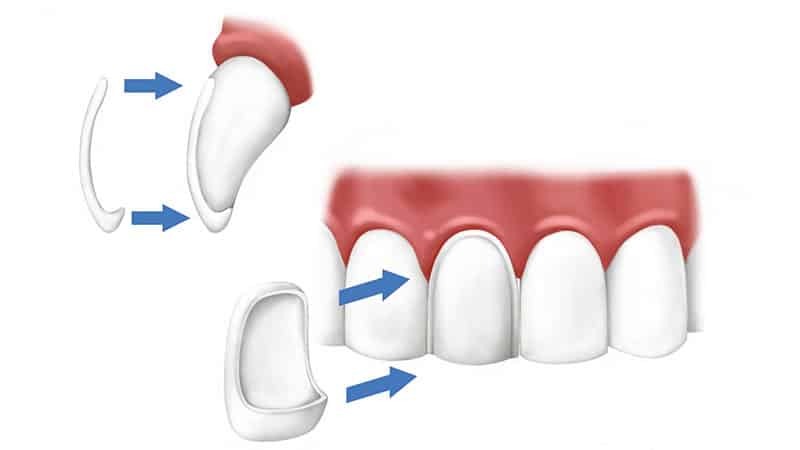 Veneers on the teeth - installation diagram