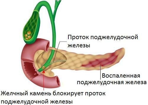 cómo tratar la colecistitis y pancreatina