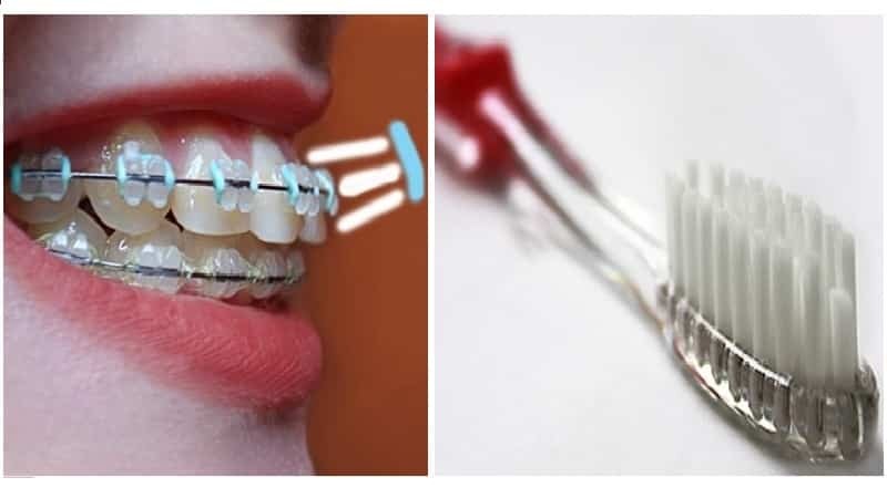 Sapphire Zahnspange: Fotos vor und nach der Installation, Bewertungen