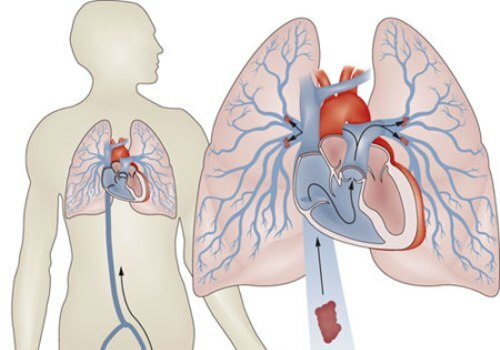 Lungeninfarkt: die Symptome, Behandlung und Prognose