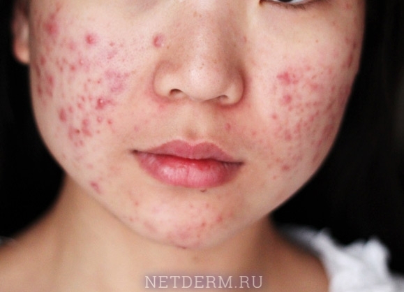 How does Vishnevsky ointment help with acne?