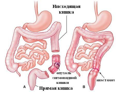 Infiammazione del colon sigmoide