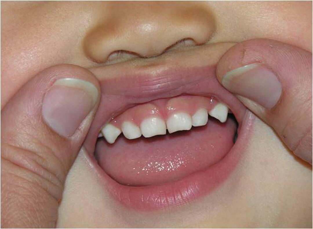 dientes caninos en los niños: el qué y dónde están
