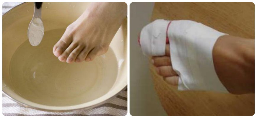 Hvordan at slippe af ligtorne på fødderne: Årsager, symptomer, behandling (professionel fjernelse, apotek udstyr og traditionelle opskrifter), forebyggelse
