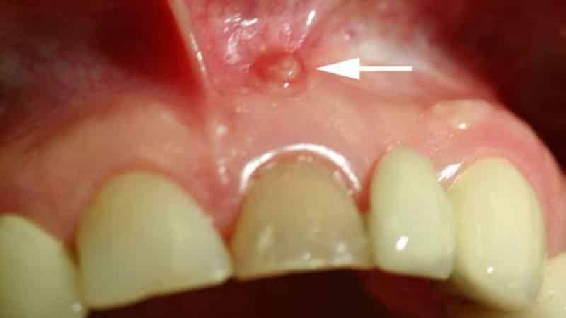 Zyste auf dem Zahnfleisch: Foto, Behandlung, Symptome