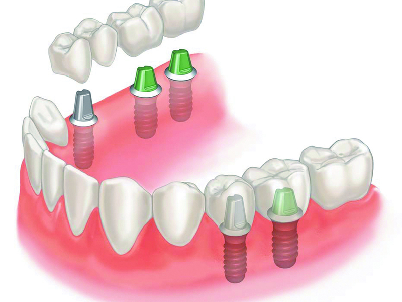 hammasmuotoilussa