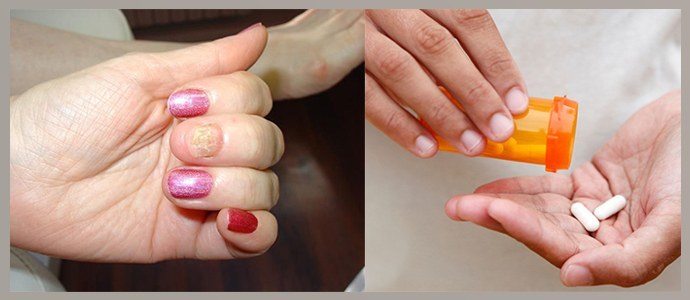 Lesiones en las uñas, uso incontrolado de antibióticos.