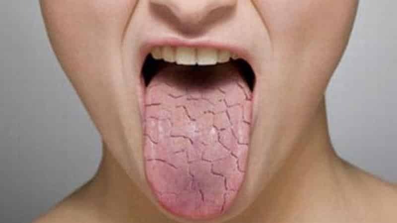 hvorfor tørr munn forårsaker