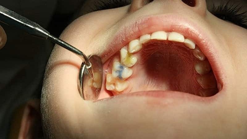 Pulpitisa mliječni zubi - liječenje