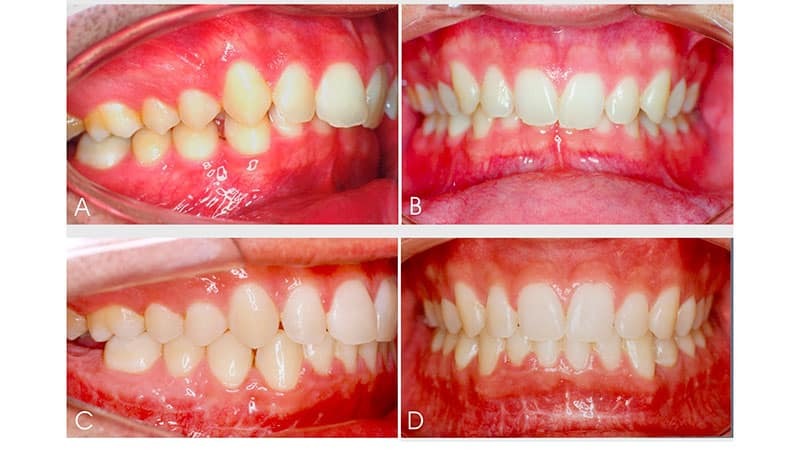 Arten von Zähnen beißen beim Menschen