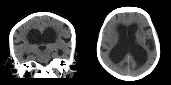 CT-skanning av hjernen