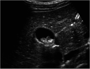 Removal of stones from the gallbladder: ultrasound or laser, consequences