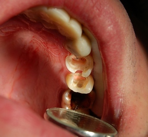 Mikä on hammaslääkärin tappi