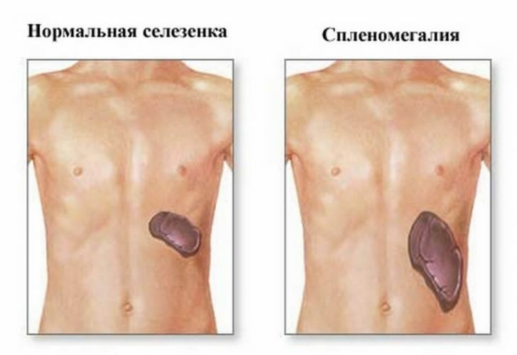 Splenomegaly of the spleen: causes, symptoms and treatment