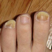 Infekce houbových nehtů