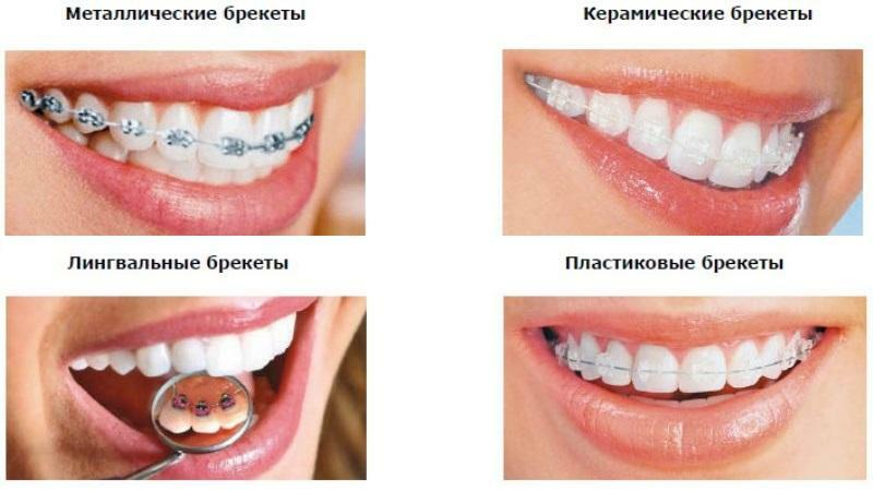 Olika typer av fästen på tänderna foto hängslen och tänder före och efter behandling