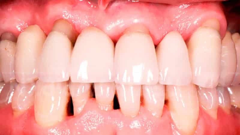 tratamiento de la enfermedad periodontal en el hogar: