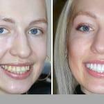 Kurven Zähne vor und nach