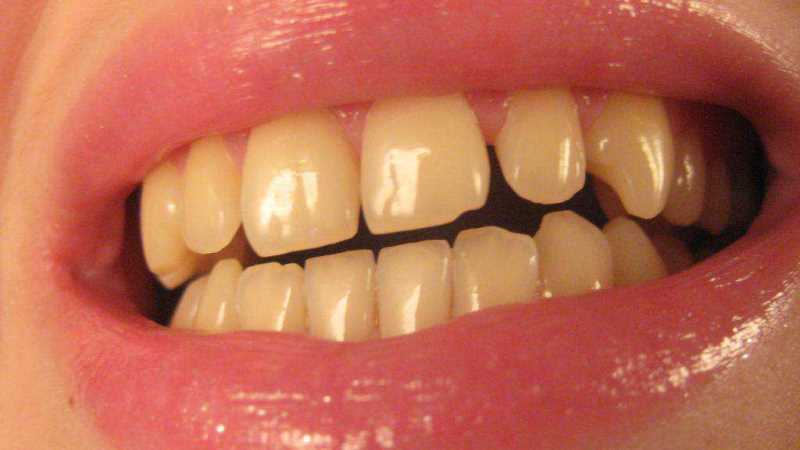 ¿Por qué los dientes de color amarillo