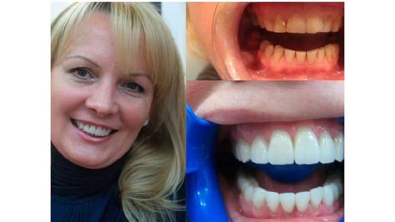 Héjak a fogak: mi az, előtt és után