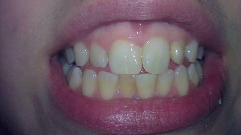 Formørket tand efter rammer barn: hvad man skal gøre
