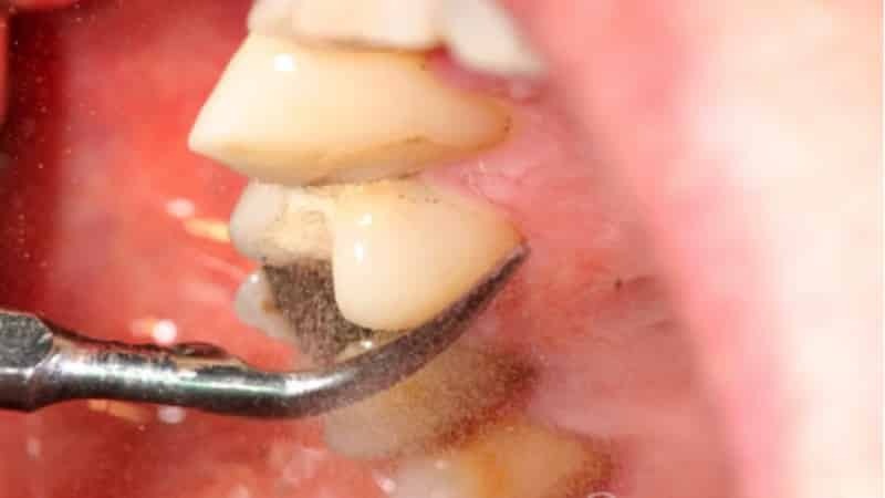 warum fährt Zahnfleisch von dem Zahn Ursachen