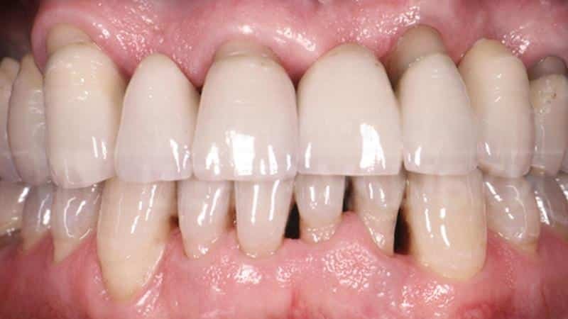 El tratamiento de la enfermedad periodontal en el hogar