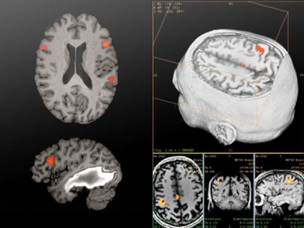 I hvilke tilfeller er MR eller CT av hjernen tildelt?