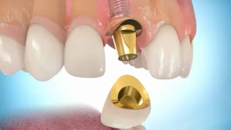 Implantation of teeth: contraindications and possible complications