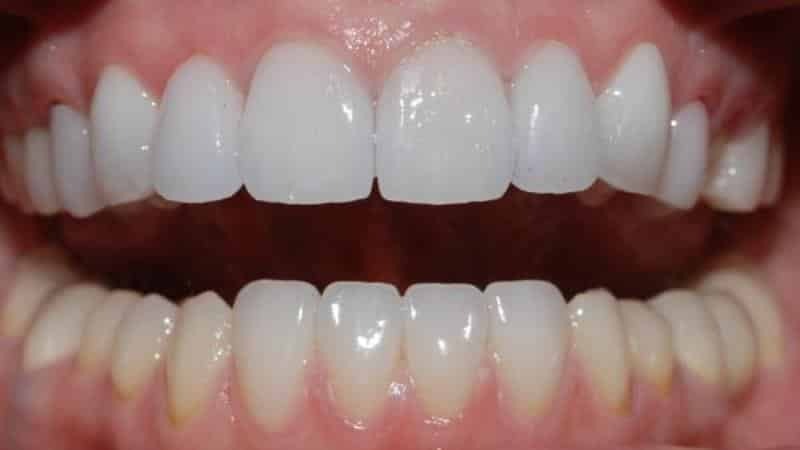 tijdelijke tand na verwijdering