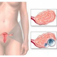 Graviditet och cyst i äggstockarna