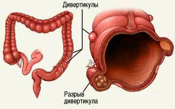 Neoplasias no intestino