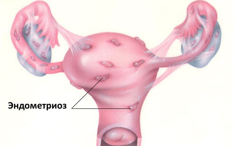 Diagnóstico de endometriose: uma pesquisa e análise