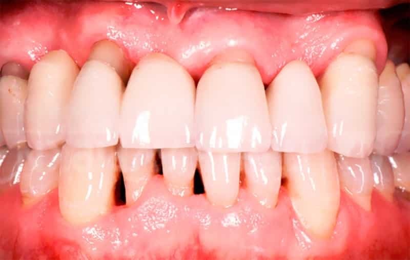 La enfermedad periodontal: una foto antes y después del tratamiento, a diferencia de la periodontitis foto