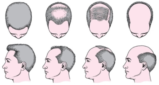 Androgen alopeci hos mænd