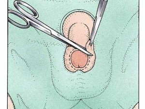 Por que a circuncisão
